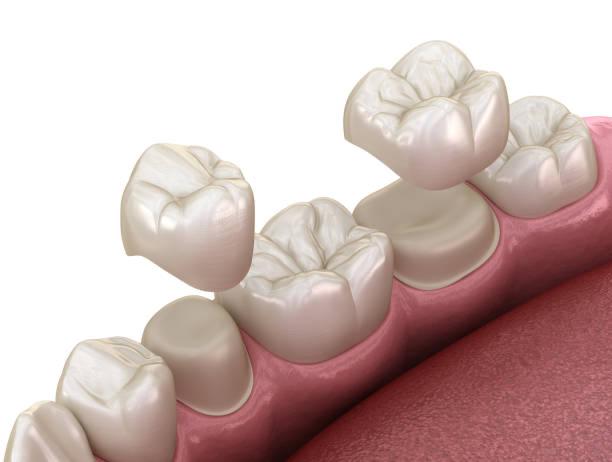 Dental bridge replacement