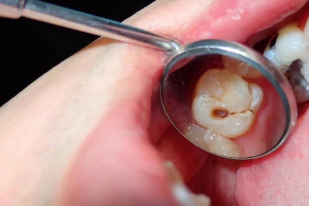 Tooth coloured filling result