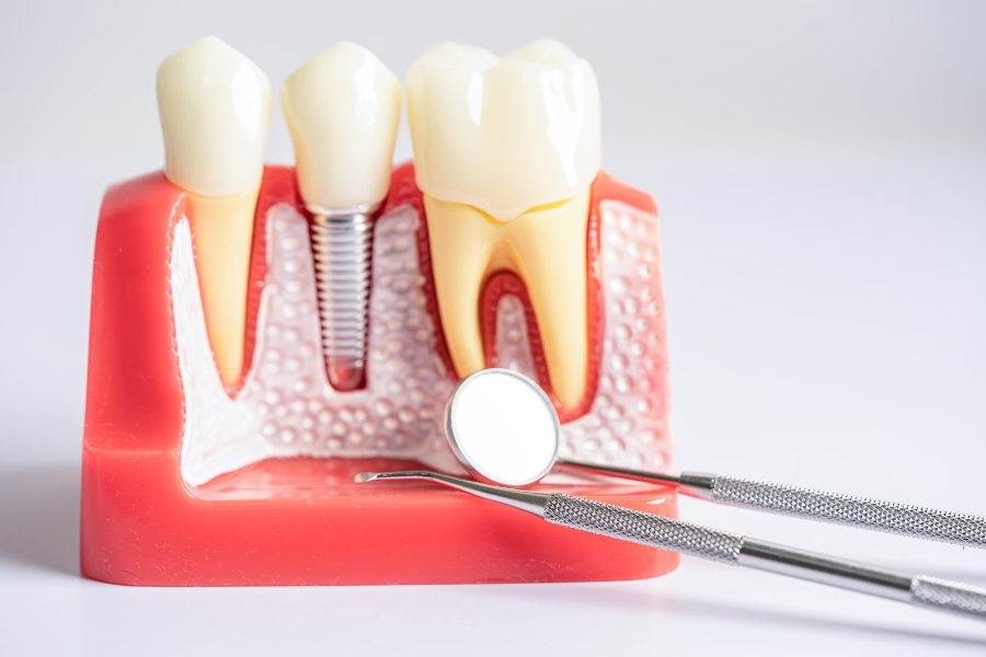 implant-restoration