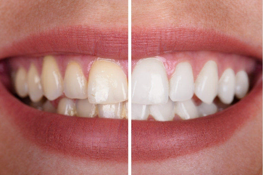Teeth whitening treatment