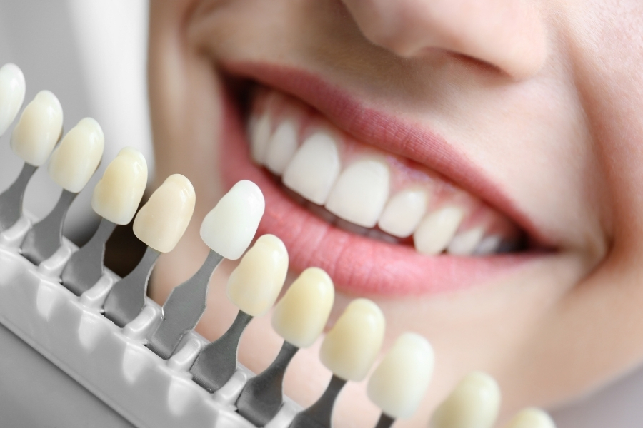 Whiter smile result
